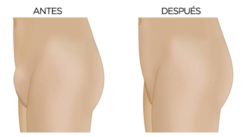 reduccion-monte-de-venus